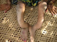 Ray of hope for fluoride-induced deformity victims in Gaya villages