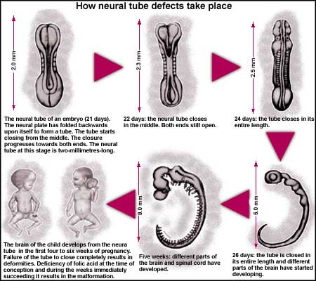 What are Neural Tube Defects? 